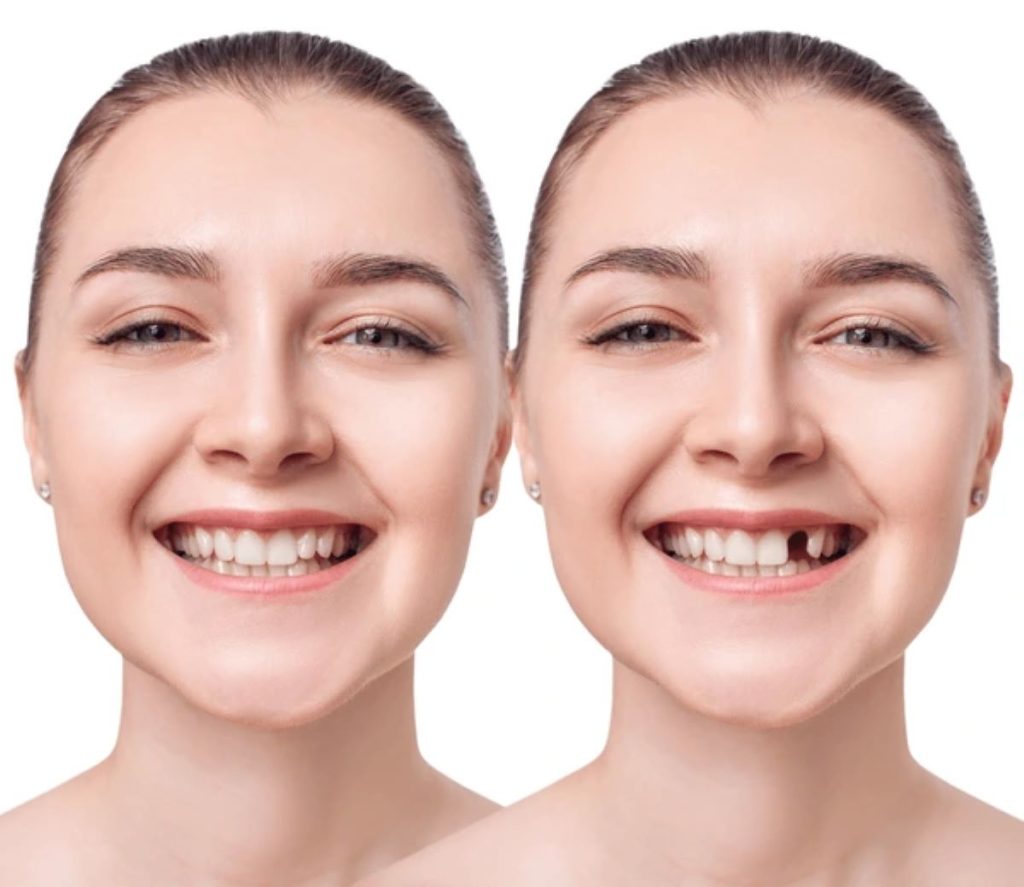 ایمپلنت دندان جلو (نکات مهم زیبایی و عملکرد)