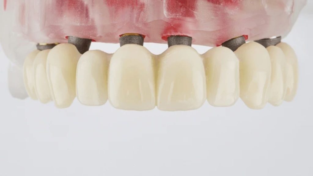 عمر ایمپلنت دندان چقدر است؟ (عوامل موثر بر ماندگاری)