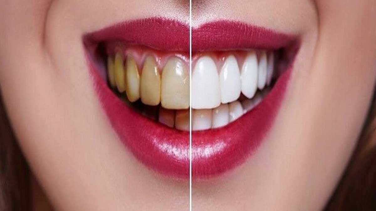 بلیچینگ دندان چیست؟ (سفید کردن دندان در مطب)