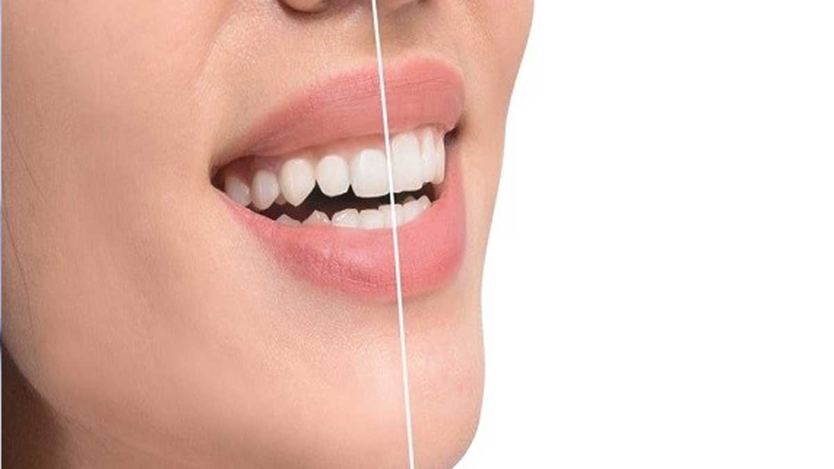 لیفت لثه چیست؟ (درمان لبخند لثه‌ای)