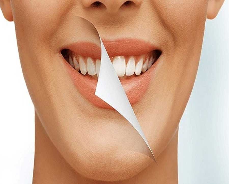 مزایای بلیچینگ دندان