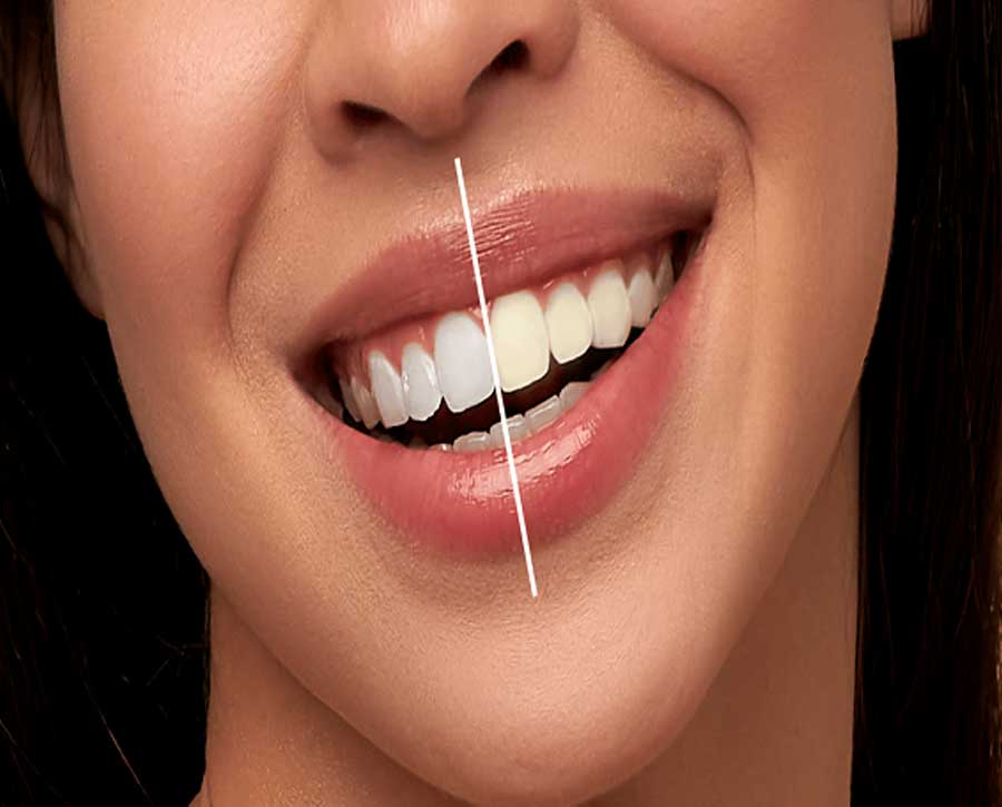 عوارض بلیچینگ دندان